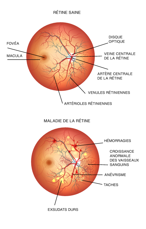 Soins Avanc s Pour La R tine Haute Vision Ophtalmologie Soins Avanc s Pour La R tine Haute Vision Ophtalmologie